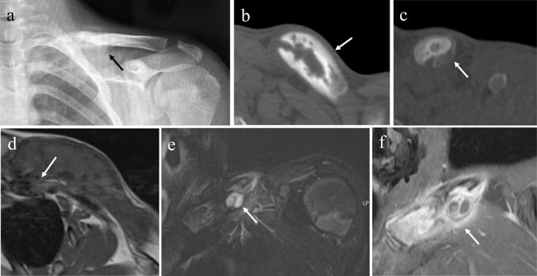 Radiograph, CT and MRI of clavicular CNO, with arrows marking an expanded sclerotic clavicle and surrounding signal change