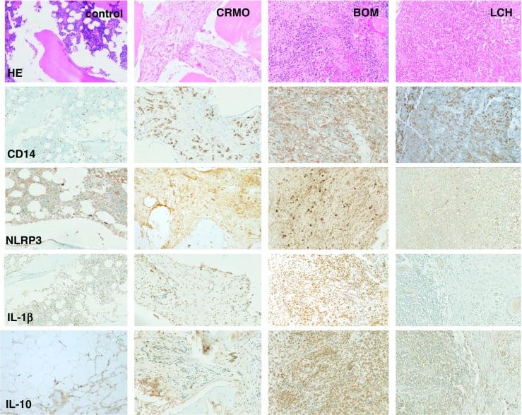 Panel of bone histology with H&E and CD14, NLRP3, IL-1 beta and IL-10 immunostains in labelled columns for control, CRMO, bacterial osteomyelitis and Langerhans cell histiocytosis