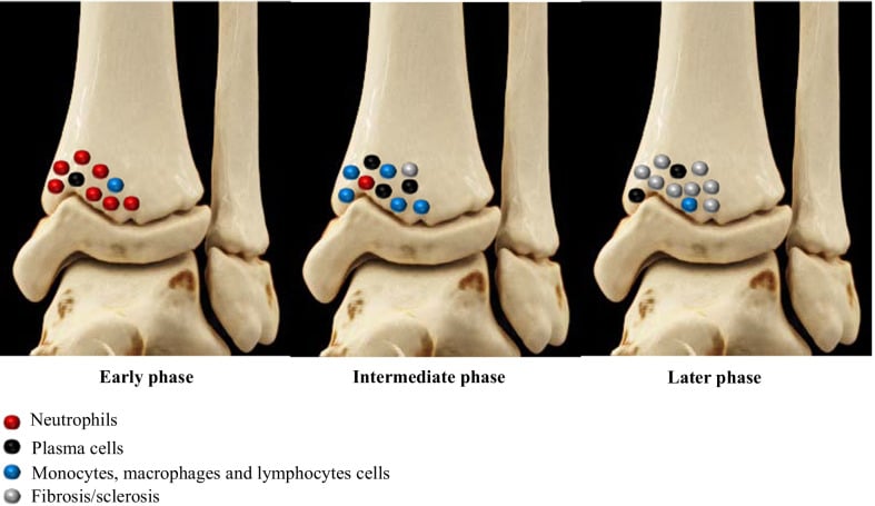 Schematic of a CNO bone lesion in three labelled phases, early, intermediate and later, with a legend for neutrophils, plasma cells, monocytes, macrophages and lymphocytes, and fibrosis or sclerosis