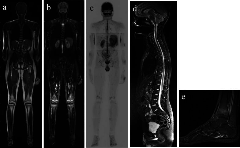 Reference whole-body MRI protocol with coronal T1, coronal STIR, diffusion imaging, sagittal spine STIR and foot STIR