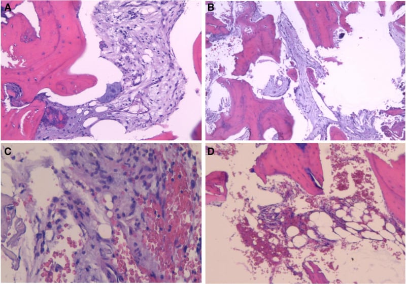 Four haematoxylin and eosin photomicrographs of a CRMO bone biopsy showing bone trabeculae, fibrous stroma and inflammatory cells