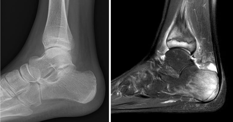 Lateral heel radiograph with no visible abnormality beside sagittal MRI showing bright marrow signal in the calcaneus