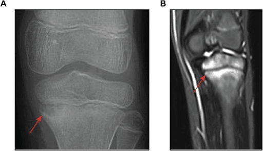 X-ray and MRI example of CRMO involving the proximal tibia