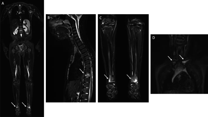 Coronal whole-body STIR MRI with arrows at both distal tibiae, sagittal spine MRI with an arrow at a lower thoracic vertebral body, coronal lower-leg MRI with arrows at both distal tibiae, and a coronal image with arrows at the sternoclavicular region