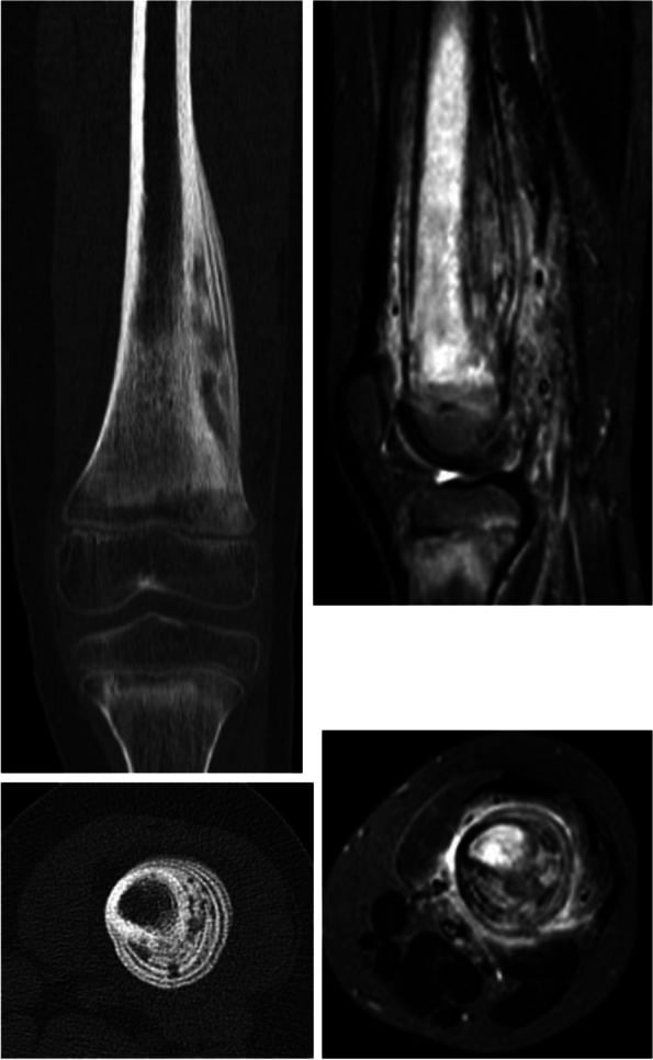 Coronal and axial CT of a lytic distal femoral CNO lesion beside sagittal and axial MRI showing bright marrow signal extending up the femur with surrounding soft-tissue change