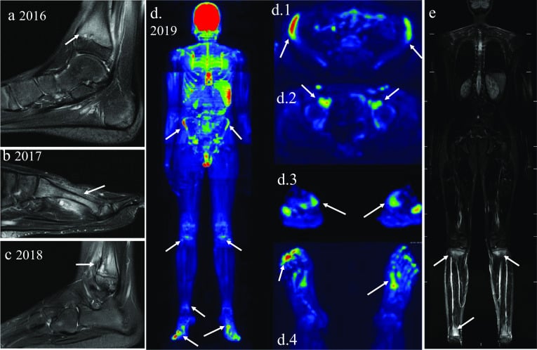Serial sagittal ankle and foot MRI dated 2016 to 2018, a 2019 whole-body colour map with axial details, and a coronal whole-body STIR, with arrows at changing lower-limb sites