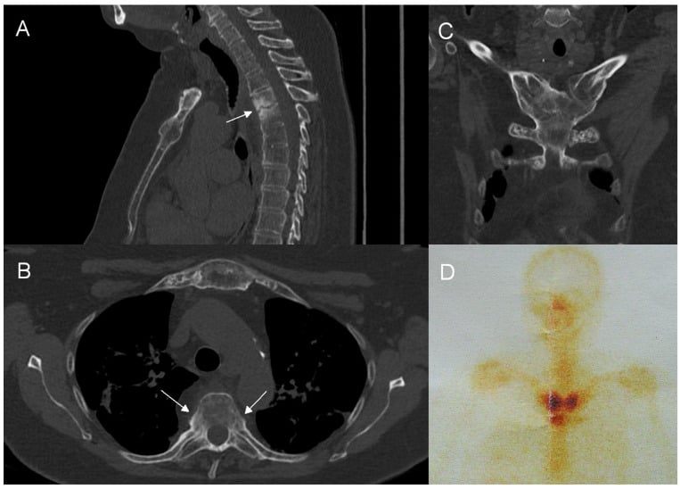 Sagittal and axial CT of the thoracic spine with arrows at a vertebra, coronal CT of the sternoclavicular region and manubrium, and bone scintigraphy with uptake at the anterior chest wall in adult SAPHO syndrome