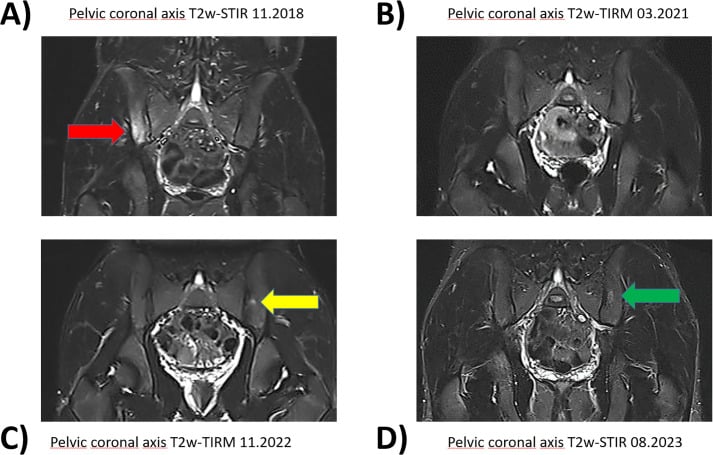 Four coronal fat-suppressed pelvic MRI studies labelled with dates from 11.2018 to 08.2023, with coloured arrows at changing sites of signal change