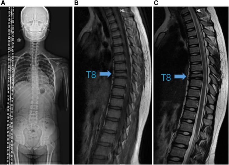 Standing whole-spine radiograph showing a coronal curve beside two sagittal thoracic MRI images with T8 labelled by an arrow