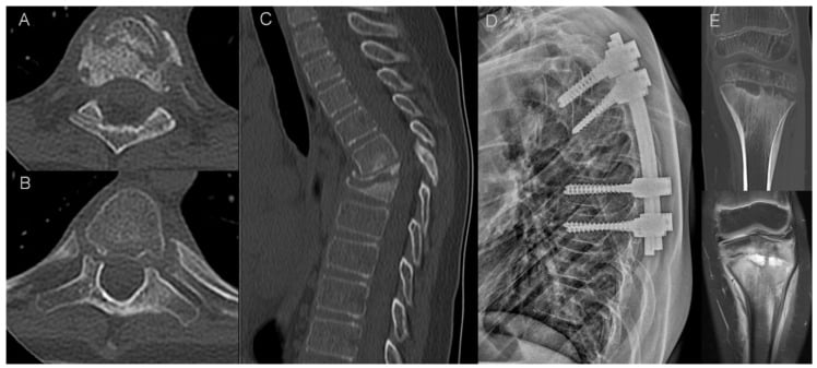 Axial and sagittal CT of erosive spinal CNO with vertebral collapse, a lateral radiograph after posterior instrumentation, and distal femoral CT and MRI