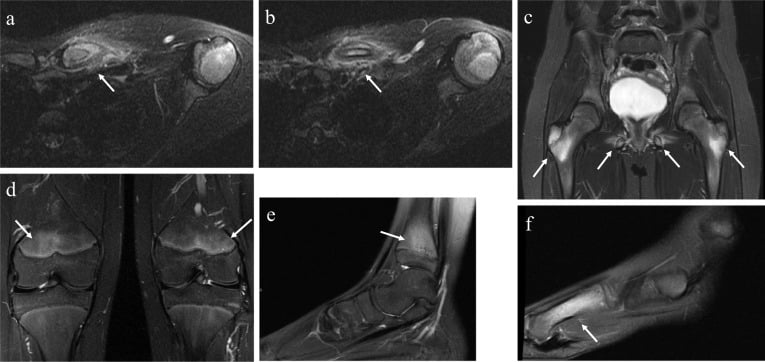 Fat-suppressed MRI panels: axial clavicle (a, b), coronal pelvis (c), coronal knees (d), sagittal ankle (e) and foot (f), with arrows marking multifocal lesions