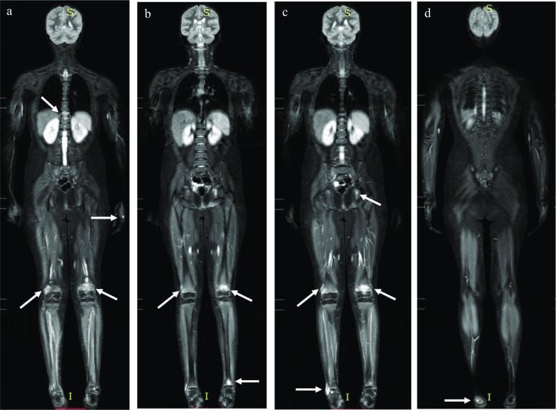 Coronal whole-body STIR MRI in four panels with arrows marking multifocal CNO lesions at a thoracic vertebra, the pelvis, both knees, a hand and the feet