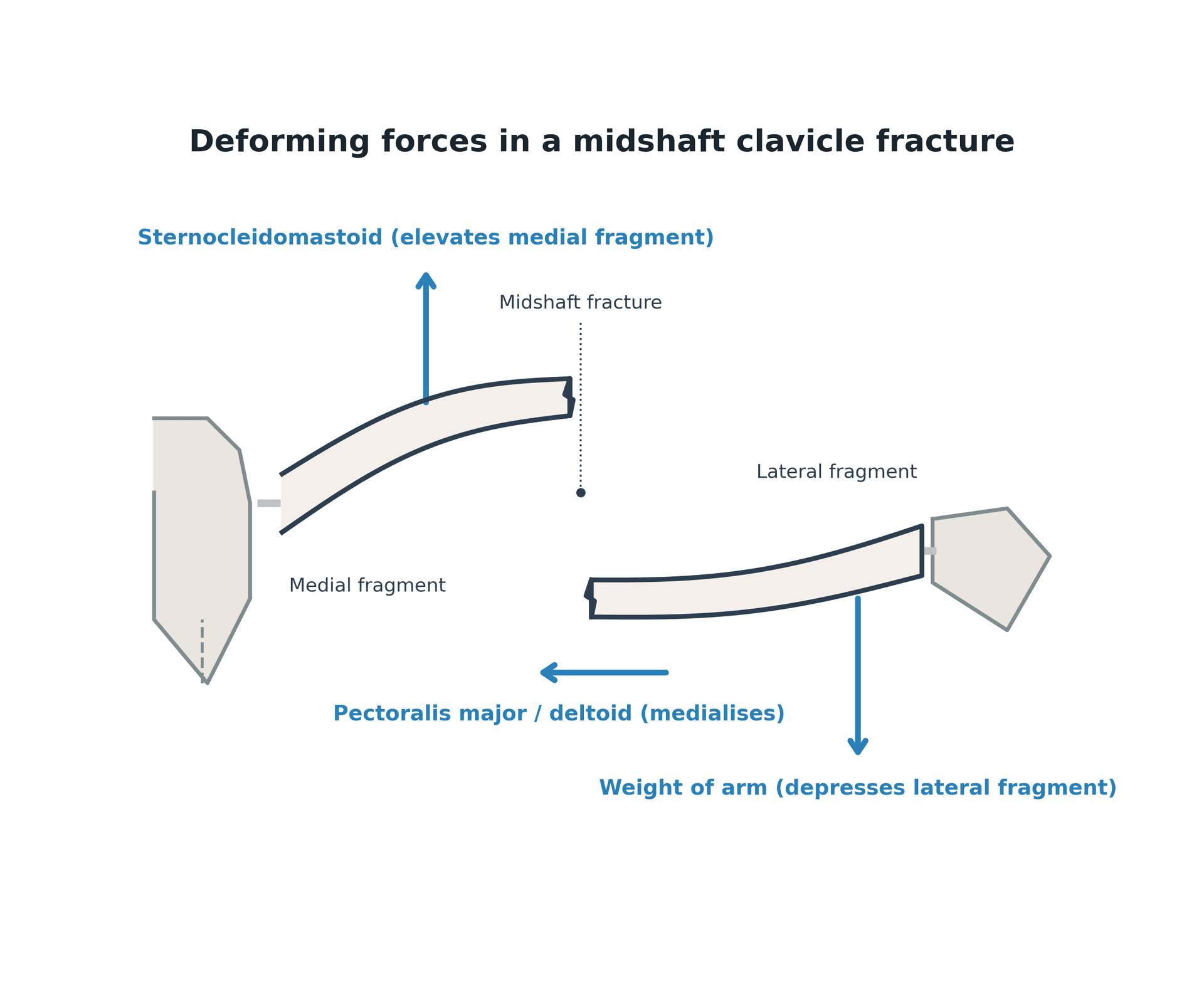 Diagram of the deforming muscle forces acting on a displaced midshaft clavicle fracture
