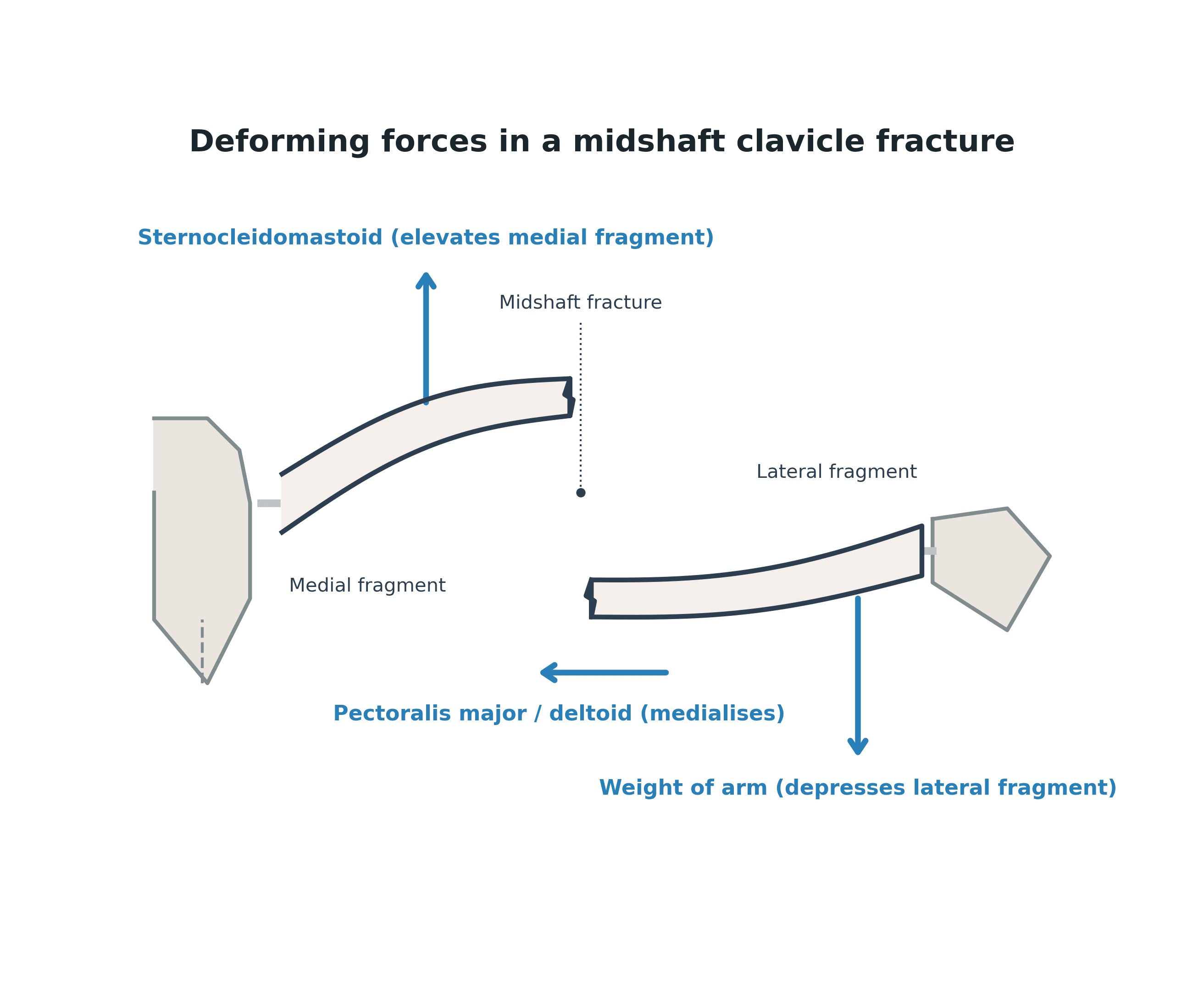 Diagram of the deforming muscle forces acting on a displaced midshaft clavicle fracture