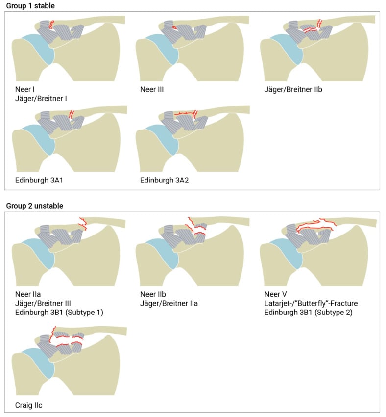 Distal clavicle fracture classification diagram showing stable and unstable types