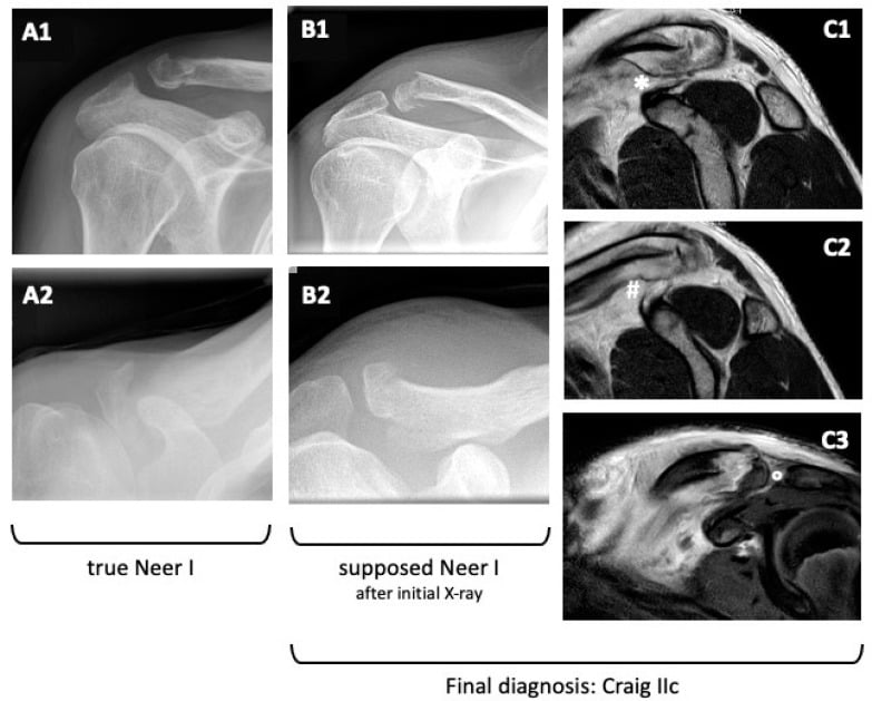 Radiographs and MRI demonstrating importance of accurate distal clavicle classification
