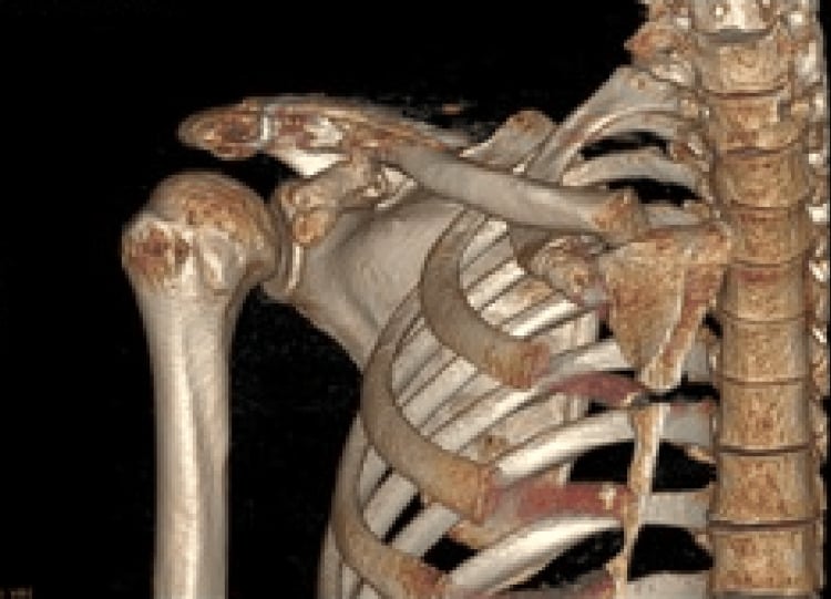 3D CT reconstruction demonstrating displaced midshaft clavicle fracture
