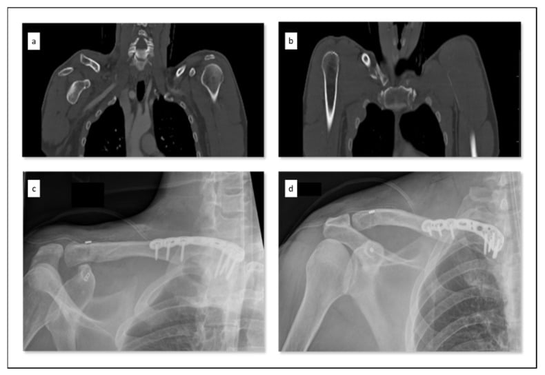 Coronal CT reconstructions and postoperative radiographs of complex clavicle combination injury