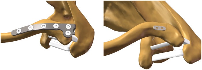 3D CAD anatomical model illustrating distal clavicle hook plate versus suture anchor reconstruction