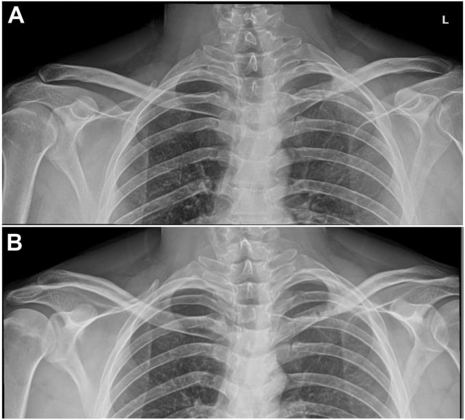 Preoperative and 3-month postoperative AP radiographs of midshaft clavicle fracture ORIF