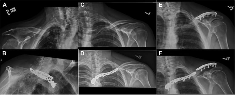 Serial radiographs of superior pre-contoured locking plate ORIF for midshaft clavicle fracture