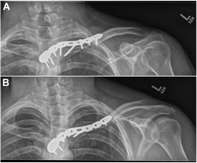 Postoperative 15° cephalic tilt radiographs of superior locking plate fixation