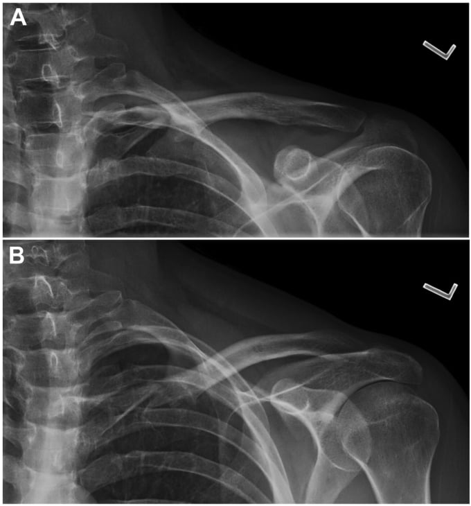 Preoperative and postoperative radiographs of titanium elastic nail (TEN) fixation for midshaft clavicle fracture