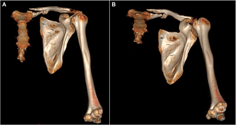 3D CT volume-rendered reconstruction demonstrating medial clavicle nonunion