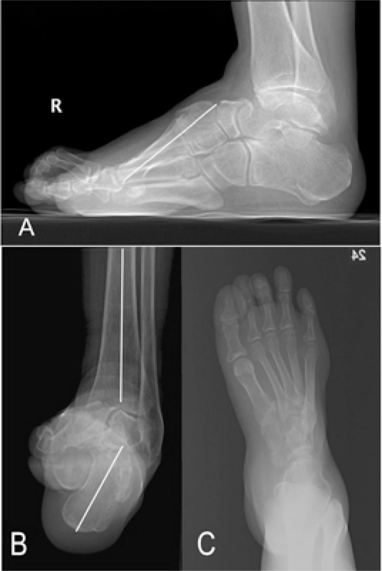 Three-panel radiograph showing severe cavovarus foot with claw toe deformities