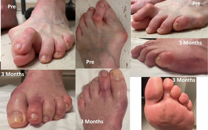 Preoperative and three-month clinical photographs showing correction of a crossover second-toe deformity after flexor tenodesis