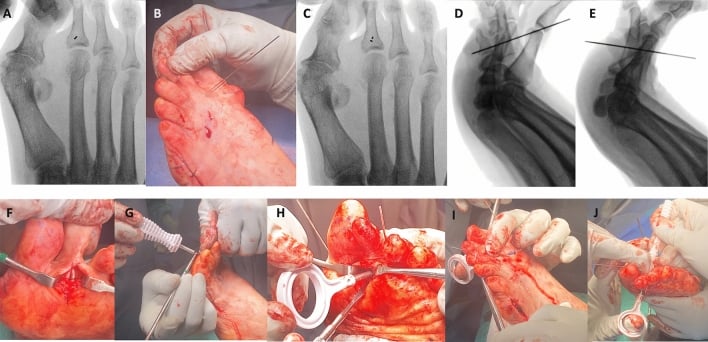 Operative and fluoroscopic sequence, panels A to J, showing localisation at the proximal phalanx, flexor tendon passage and fixation to the proximal phalanx