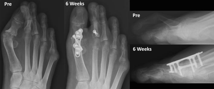 AP and lateral radiographs before and six weeks after first-ray fixation and correction of a crossover second toe