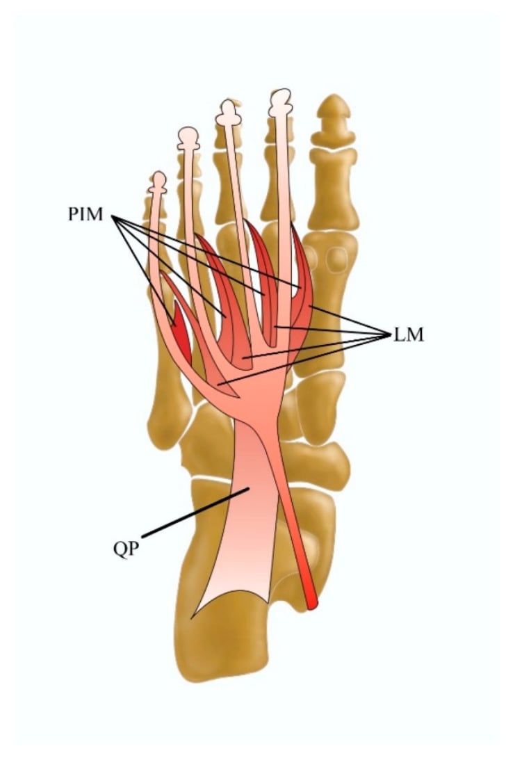 Plantar anatomical diagram of the forefoot labelling the plantar interossei (PIM), lumbricals (LM) and quadratus plantae (QP) beneath the lesser metatarsals