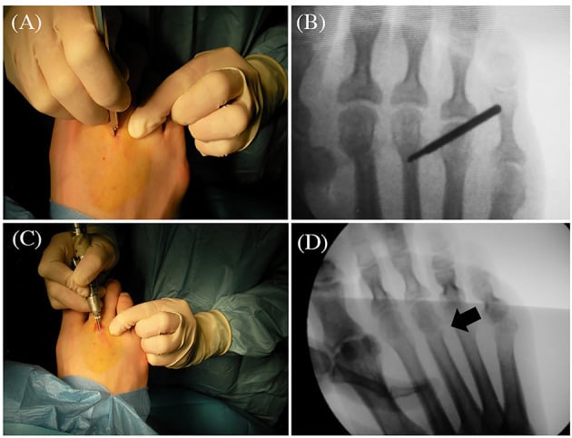 Clinical and fluoroscopic sequence, panels A to D, showing a minimally invasive distal metatarsal osteotomy