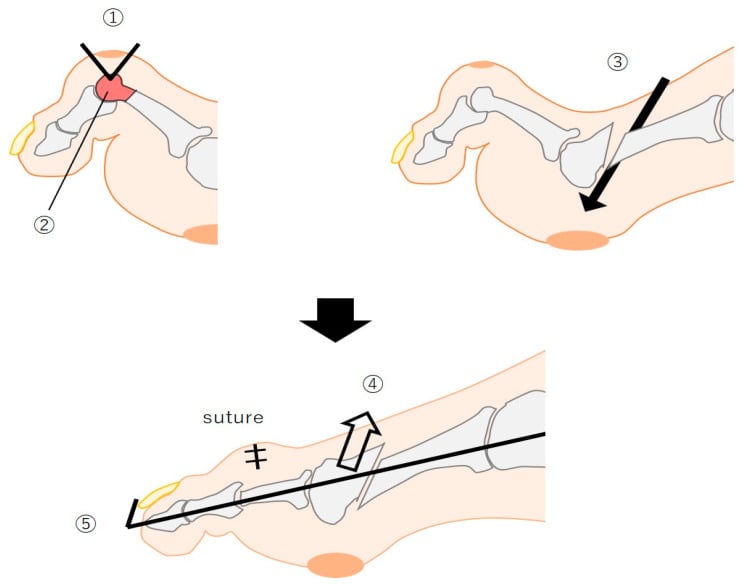 Schematic showing PIP resection arthroplasty, oblique metatarsal shortening osteotomy and K-wire stabilisation