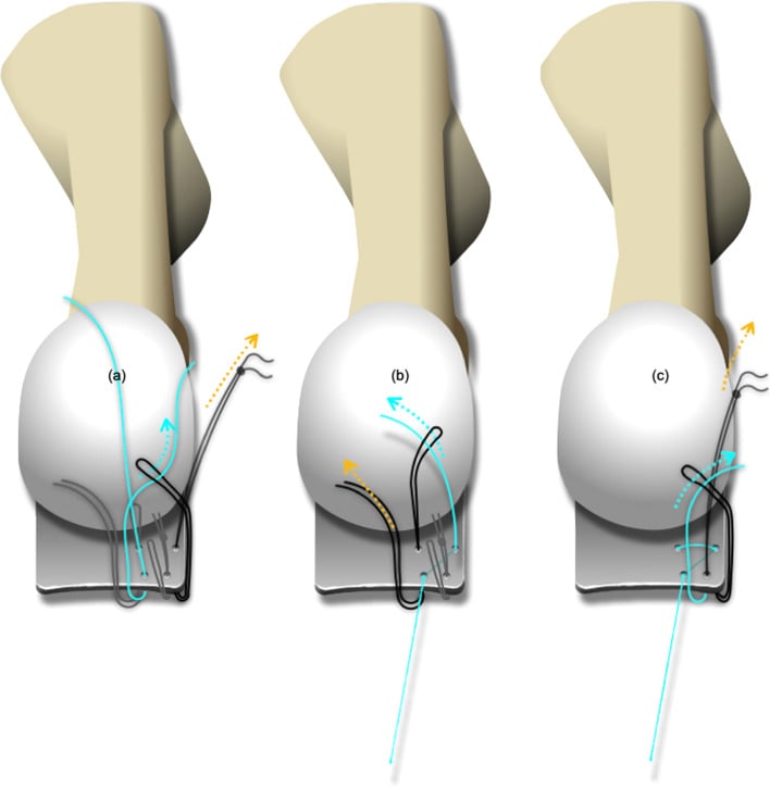 Three-step schematic, panels a to c, showing suture-loop passage through a torn lesser MTP plantar plate beneath the metatarsal head