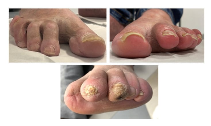Clinical photographs showing transfer claw toes, multiple floating toes and a pressure lesion after flexor tenotomy