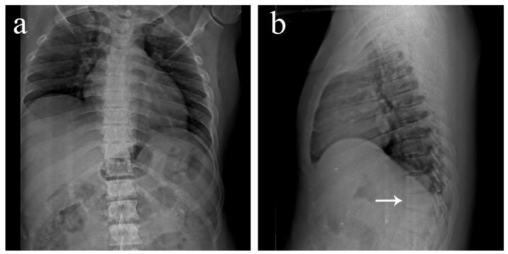 Thoracic spine radiographs showing spinous process fracture
