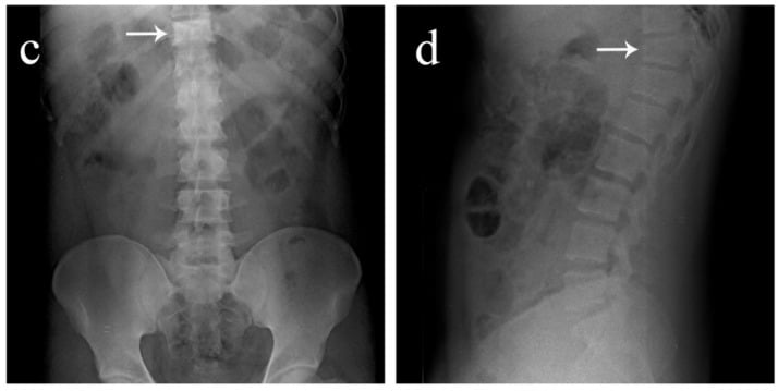 Lower thoracic spine radiographs showing spinous process abnormality