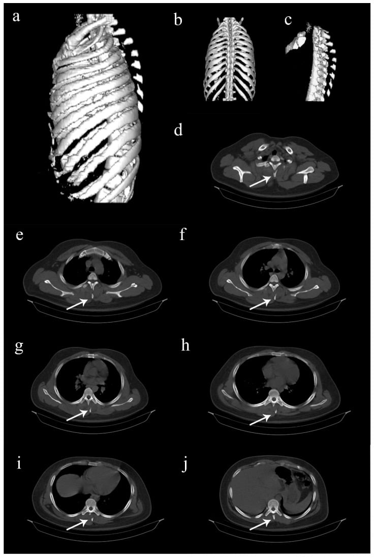 CT imaging of multiple spinous process fractures