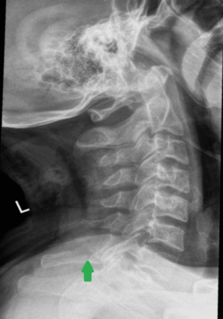 Follow-up lateral cervical radiograph showing an unchanged C7 spinous process fracture