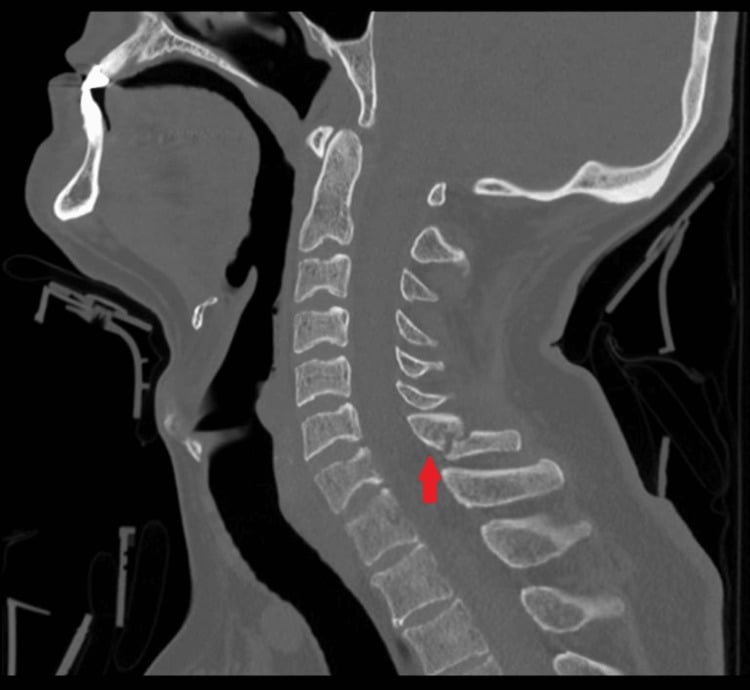 Sagittal CT showing an oblique minimally displaced C7 spinous process fracture