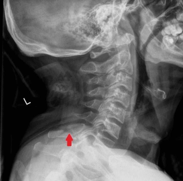 Lateral cervical radiograph showing a C7 spinous process fracture marked by an arrow