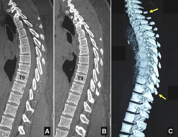 Sagittal and three-dimensional CT showing contiguous C6 to T9 spinous process fractures