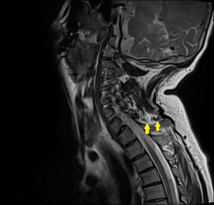 Sagittal cervical MRI showing interspinous ligament tearing and oedema below a C7 spinous process fracture