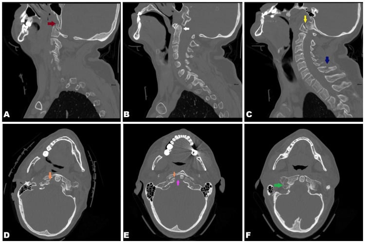 Multiplanar cervical CT showing a C7 spinous process fracture together with additional missed injuries