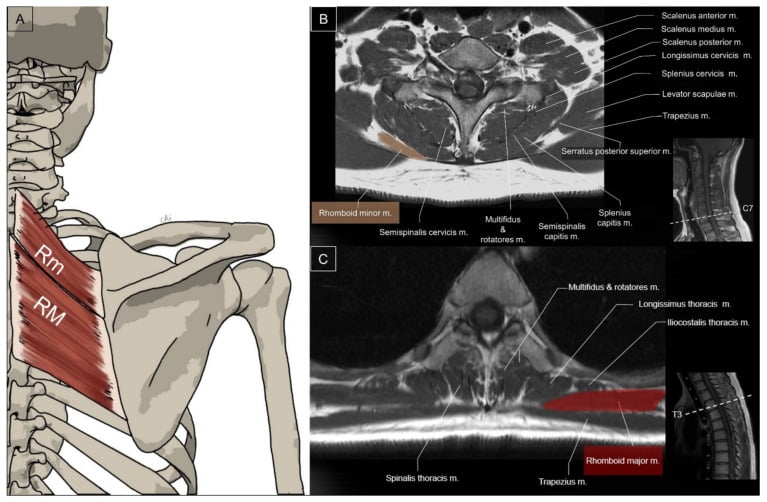 Illustration and axial MRI showing the rhomboid minor and major muscles attaching beside the thoracic spinous processes