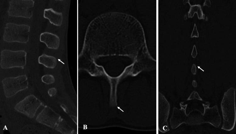 Sagittal axial and coronal CT showing union of a lumbar spinous process fracture after conservative treatment