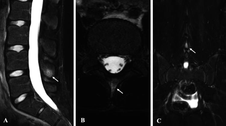 Sagittal axial and coronal STIR MRI showing oedema at the L4 spinous process in an adolescent athlete