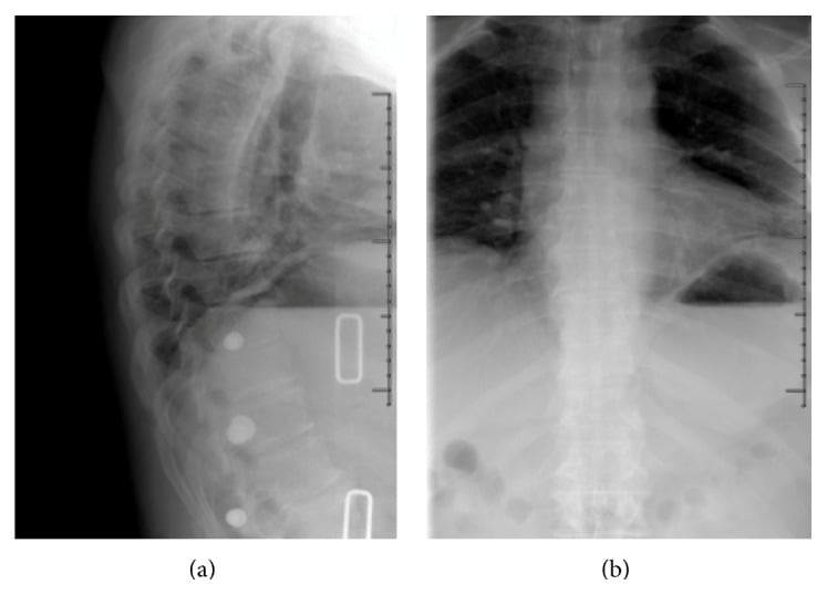 Lateral and AP thoracic radiographs in a brace at ten weeks after multiple spinous process fractures